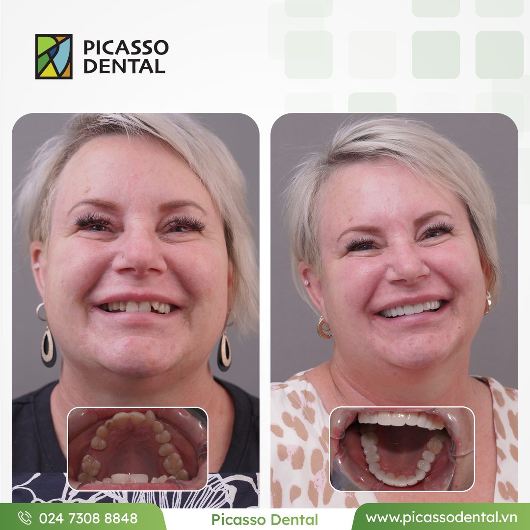 Veneers + crown — anterior — Picasso Dental patient case