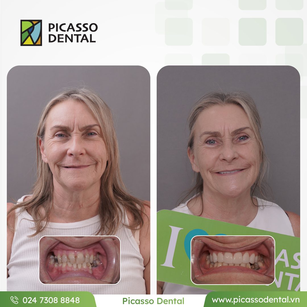Veneers + crowns — full smile — Picasso Dental patient case