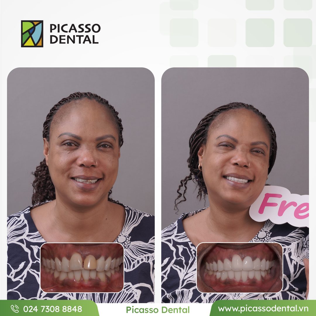 Veneers + crowns — Picasso Dental patient case